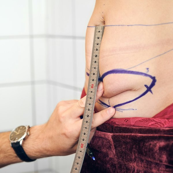 Focus sur l'intervention dite lipo Vaser